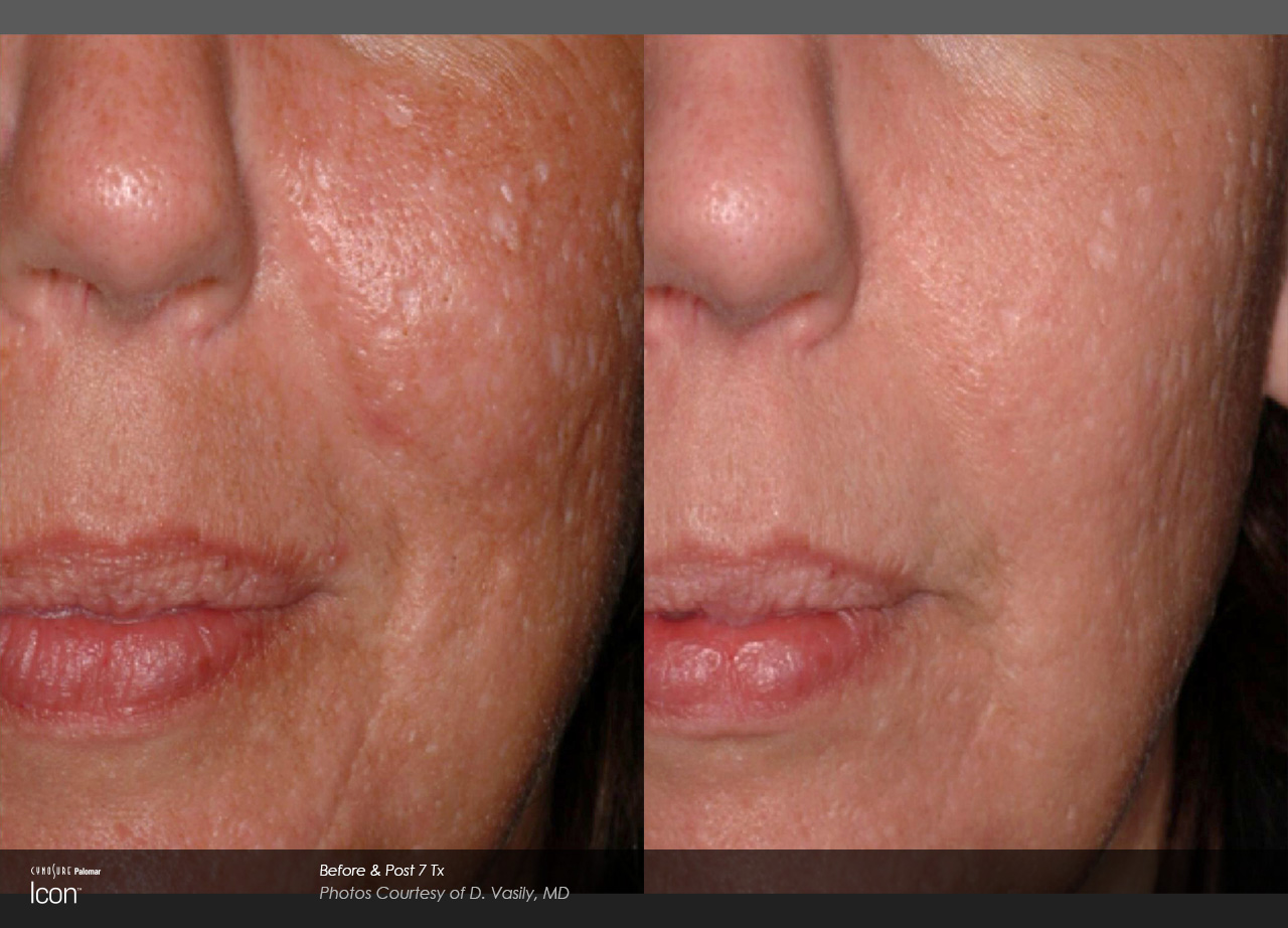 Scar-Removal-Before-and-After-Images-1